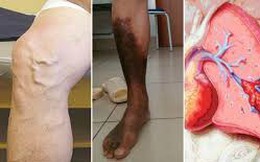 Đừng đùa với những đường gân "loằng ngoằng", không cẩn thận có thể biến chứng vào tim, phổi
