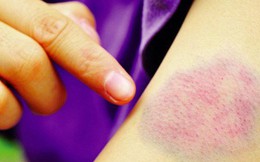 Giảm tiểu cầu vô căn, chữa trị thế nào?