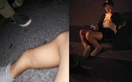 Chụp chân gãy khoe lên Facebook, thanh niên bất ngờ bị nhân chứng tại hiện trường bóc mẽ