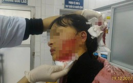 Khởi tố vụ nữ sinh bị đâm rách mặt 14cm