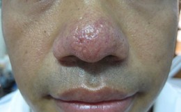 Trên mặt có dấu hiệu này, có thể trong người đang có trọng bệnh