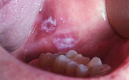 Những bệnh răng miệng do thuốc lá gây ra
