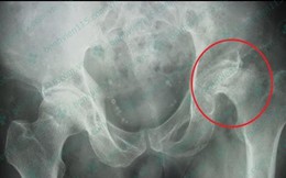 Uống nhiều rượu, hút nhiều thuốc lá, ai ngờ hoại tử cả... xương đùi