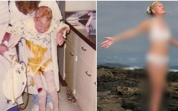 Đứa trẻ 7 tuổi toàn thân bốc cháy như đuốc sau tai nạn kinh hoàng, 30 năm trôi qua ai cũng tròn mắt khi nhìn thấy cơ thể cô ấy