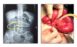 Bác sĩ cảnh báo: Viên bi nam châm đồ chơi cho trẻ em hiểm họa khôn lường