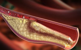 Liệu pháp đơn giản giúp giảm cholesterol