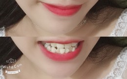 Có một nỗi đau mang tên răng 9-6-3-0: Đi đâu cũng tự ti, cười không dám cười lớn