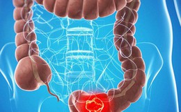 Triệu chứng phổ biến của polyp đại trực tràng, nếu phát hiện nên khám để hạn chế biến chứng