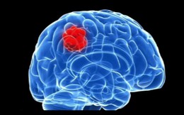 Chuyên gia bệnh viện K Trung ương chỉ ra 8 bất thường có thể là dấu hiệu của u não