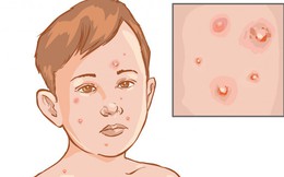 Thủy đậu đang vào mùa:  Dấu hiệu sớm nhất, cách chăm sóc và phòng bệnh bạn nên làm ngay
