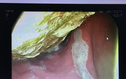 Đau bụng dữ dội, bác sĩ nội soi phát hiện ra "thủ phạm" bất ngờ
