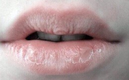 Chuyên gia chỉ cách: Phát hiện ra ung thư sớm bằng những bất thường trên môi