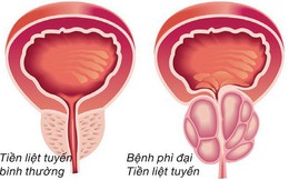 Chuyên gia lý giải nguyên nhân gây phì đại tuyến tiền liệt ở nam giới, triệu chứng và phương pháp điều trị