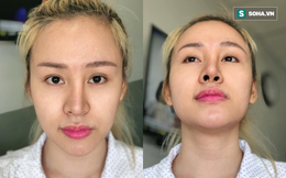 Bà Tưng gặp biến cố thẩm mỹ, sụn mũi sắp chọc đến gần mắt