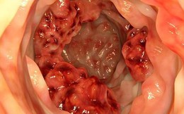 6 nhóm người cần sàng lọc ung thư đại trực tràng: Đọc ngay để xem có mình