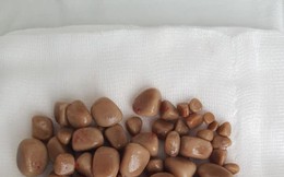 25 tuổi có cả tá sỏi trong thận: BS chỉ ra "thủ phạm" là thói quen nhiều bạn trẻ đang mắc