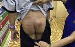 Vết bầm tím trên cơ thể bé trai ở Sài Gòn hé lộ nghi vấn bạo hành