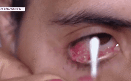 Cô gái đau đớn khóc ra 50 giọt nước mắt pha lê mỗi ngày khiến bác sĩ 'bó tay'
