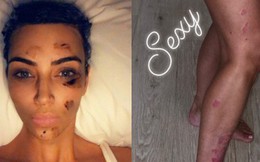 Kim Kardashian gây sửng sốt với đôi chân loang lổ và gương mặt bôi đầy thuốc vì bị bệnh vảy nến