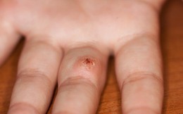 Bị sốc nhiễm trùng nguy kịch do khều gai ở tay