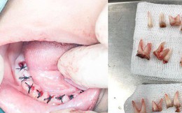 Lặp đi lặp lại thói quen tai hại này mỗi ngày, bố mẹ khiến đứa con 4 tuổi mất đi toàn bộ 18 chiếc răng