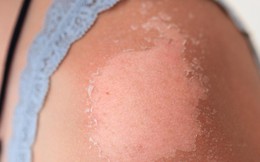 Điều gì làm cho làn da của bạn đỏ sau khi bị cháy nắng?