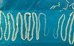 Hiếm gặp: Hai con sán dây dài 2m ký sinh trong người đàn ông