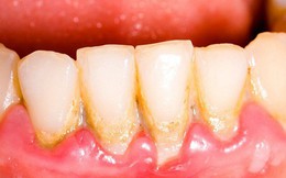 Cảnh báo: Viêm nha chu có thể gây rụng răng