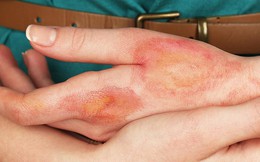 Từ hình ảnh dùng kem đánh răng chữa bỏng khiến bàn tay sưng phồng nghiêm trọng, bác sĩ khuyến cáo việc nên làm khi bị bỏng