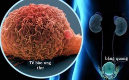 Cảnh báo căn bệnh ung thư rất hay gặp trong các ung thư đường tiết niệu