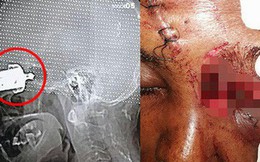 Người phụ nữ bị mù mắt vì sai lầm thường gặp ở các bà nội trợ khi dùng nồi áp suất trên bếp gas