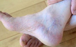 4 triệu chứng dễ thấy ở bàn chân, cảnh báo gan của bạn đang hoạt động kém