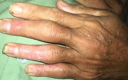 Nghe lời chữa bệnh vảy nên theo thầy lang, bệnh nhân lãnh hậu quả nặng nề là các khớp chân - tay - gối sưng to đến biến dạng
