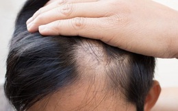 Rụng tóc bao nhiêu sợi trong một ngày bạn cần nghĩ tới vấn đề bệnh lý và nguy cơ hói đầu