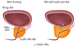 Căn bệnh "khó nói" khiến nam giới tiểu nhiều, tiểu gấp: 3 bước để phát hiện và điều trị