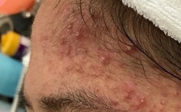 Thói quen cực xấu khiến da mặt càng ngày càng lồi lõm, mụn mọc chi chít