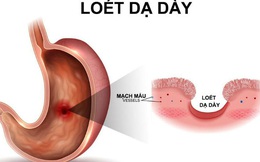 Dạ dày bị tàn phá mỗi ngày vì 4 sai lầm khi ăn: Không sớm thay đổi thì hậu quả nặng nề