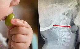 Bác sĩ nhi cảnh báo bố mẹ bỏ qua loại trái cây này khi đi siêu thị nếu không muốn "đau tim" vì con bị hóc nghẹn