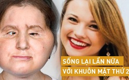 Hành trình của người phụ nữ trẻ nhất thế giới được cấy ghép khuôn mặt từ người hiến tặng và cuộc chiến với tử thần kéo dài 31 tiếng