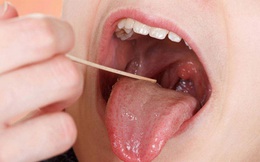 Ung thư lưỡi có thể phát hiện sớm?