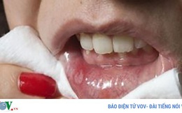 Cách thoát khỏi sự khó chịu của nhiệt miệng nhanh nhất