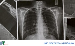 12 dấu hiệu cảnh báo phổi của bạn đang gặp vấn đề
