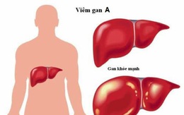 Nhận biết bệnh viêm gan A