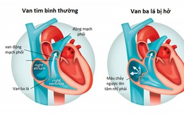 Hở van tim có dễ phát hiện?