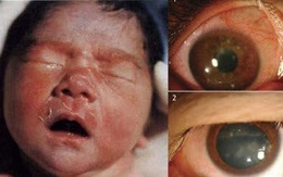Bé sơ sinh 3 ngày tuổi mắc bệnh lậu, nguyên nhân không thể ngờ