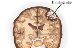 Những triệu chứng cảnh báo u màng não
