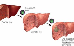 Virus viêm gan C – 'sát thủ thầm lặng' gây ung thư gan