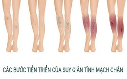 Suy giãn tĩnh mạch chân - âm thầm nhưng đau đớn