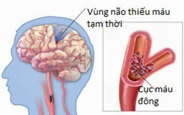 Chớ xem thường thiếu máu não cục bộ tạm thời