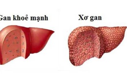 Bệnh xơ gan cần kiêng gì?